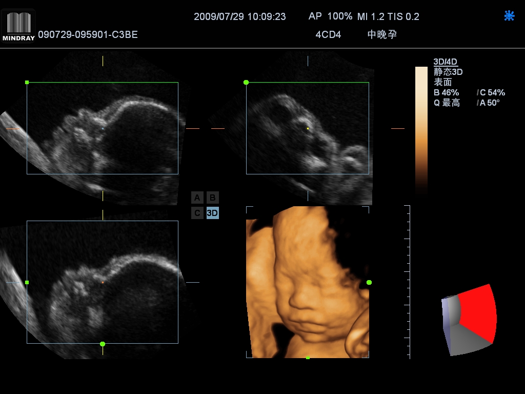 Fetal Face-3D-2