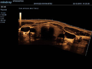 7L4A_Thyroid_iScape_Tint B_1.