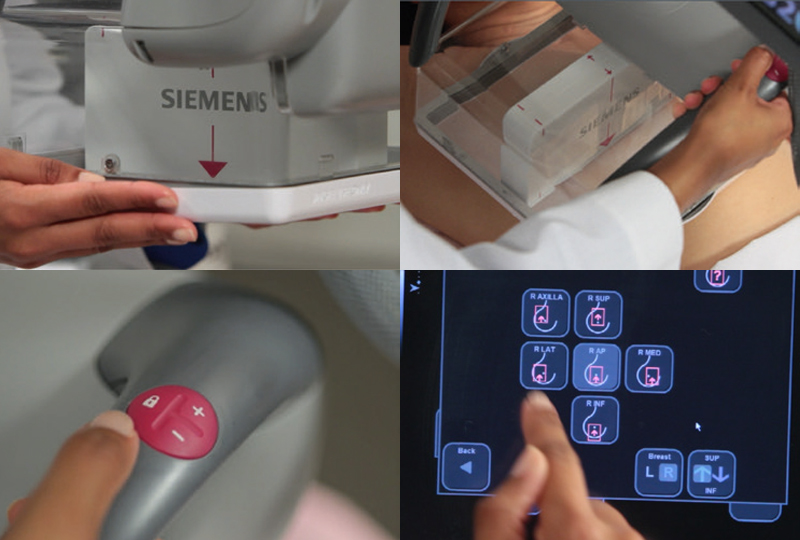 Siemens S2000 ABVS