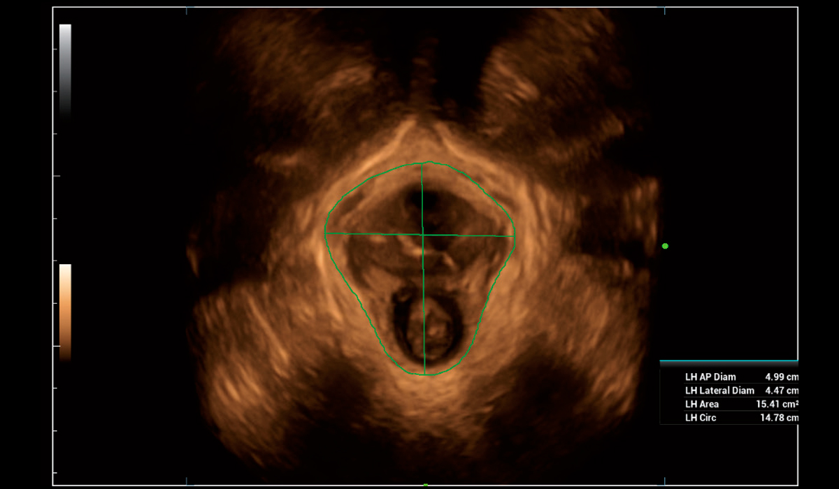 Mindray-Smart-Pelvic