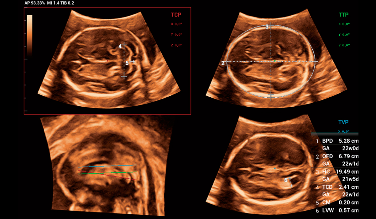 Mindray-Smart-Planes-CNS