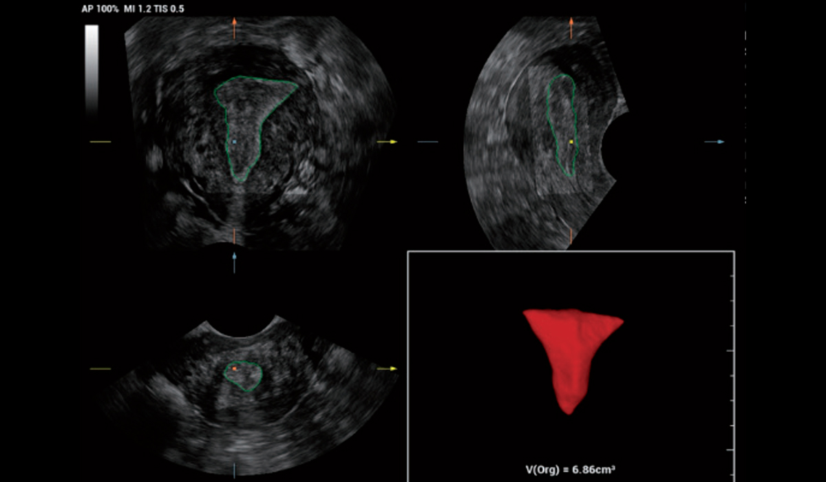 Mindray-Smart-V-Trace