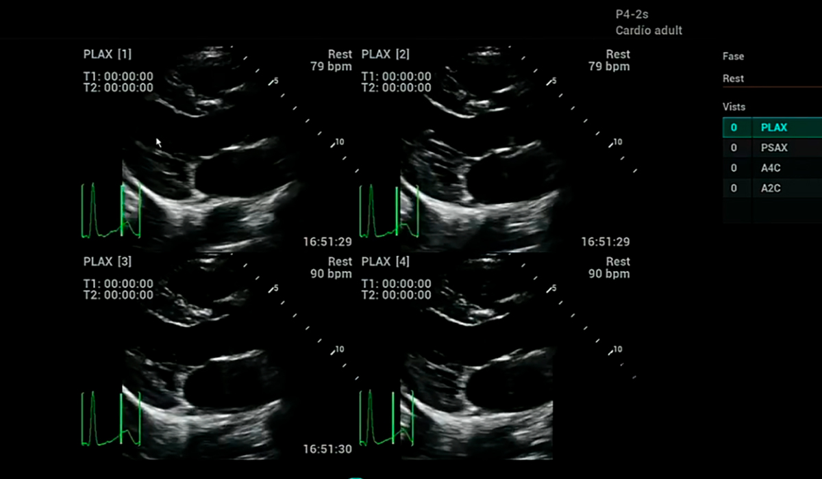 Mindray MX7 Echo Stress