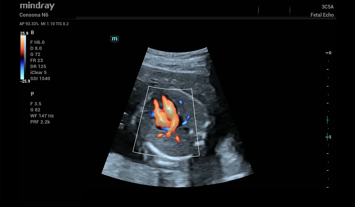 Mindray Consona N6 Pro