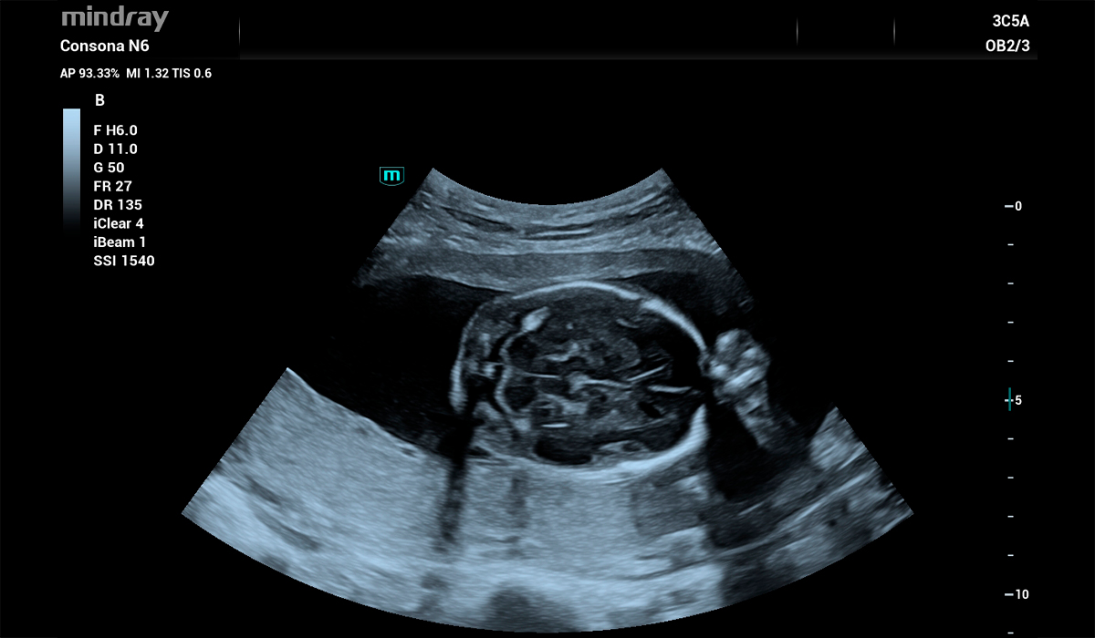 Mindray Consona N6 Pro