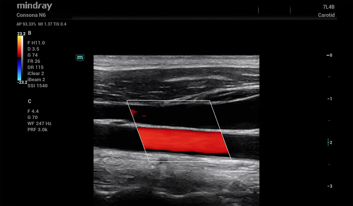 Mindray Consona N6 Pro