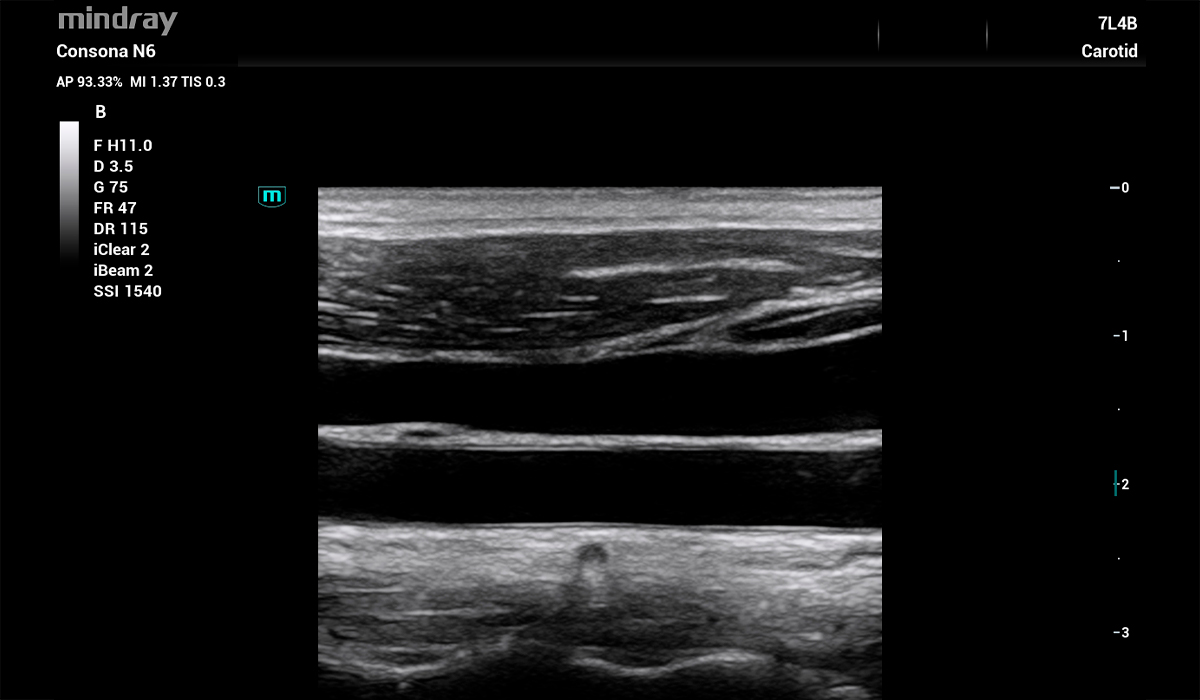 Mindray Consona N6 Pro