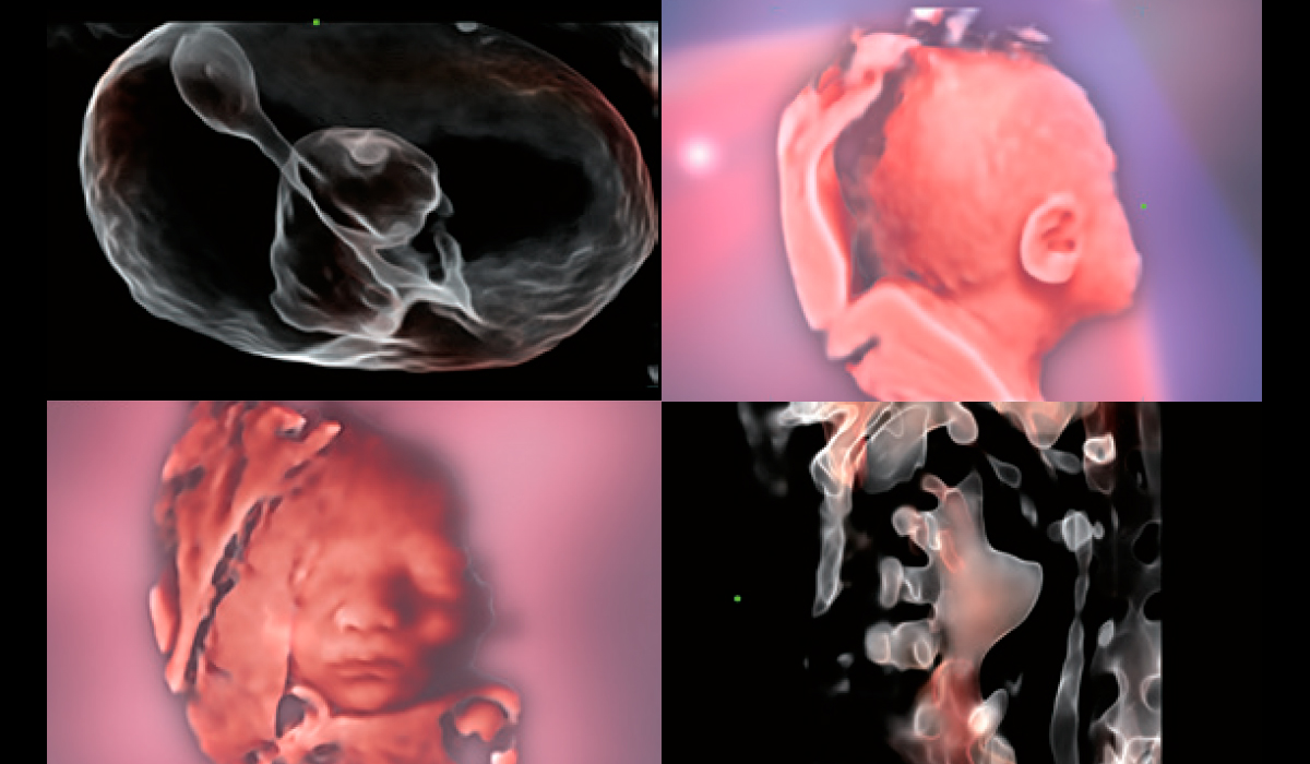 Mindray-iLive-Hyaline