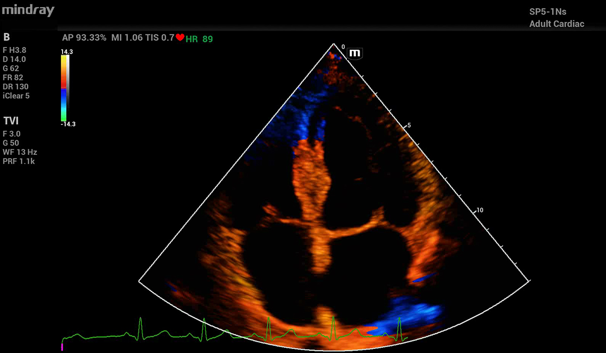 Mindray MX7 Elite Edition