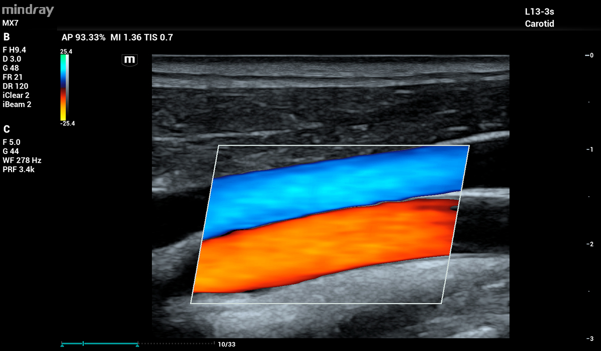 Mindray MX7 Elite Edition
