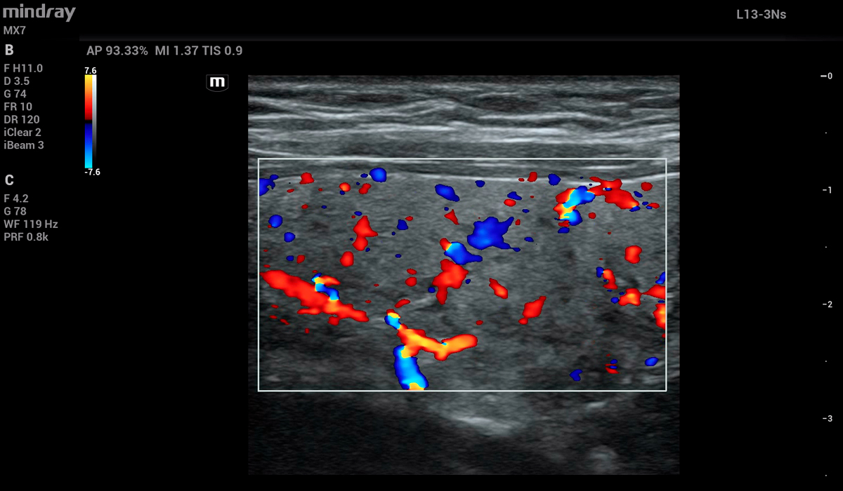 Mindray MX7 Elite Edition