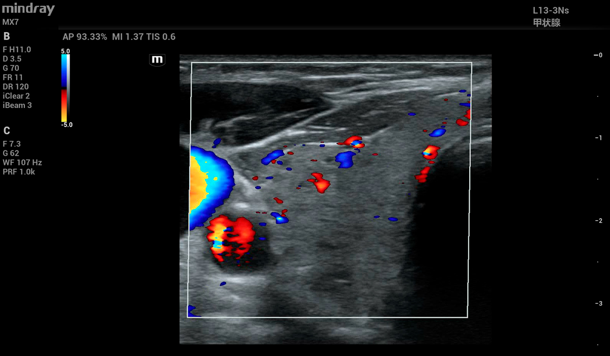 Mindray MX7 Elite Edition