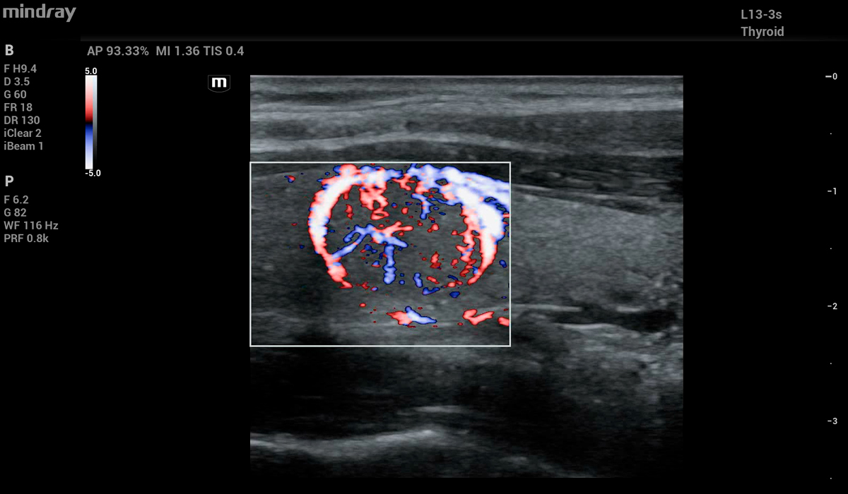 Mindray MX7 Elite Edition