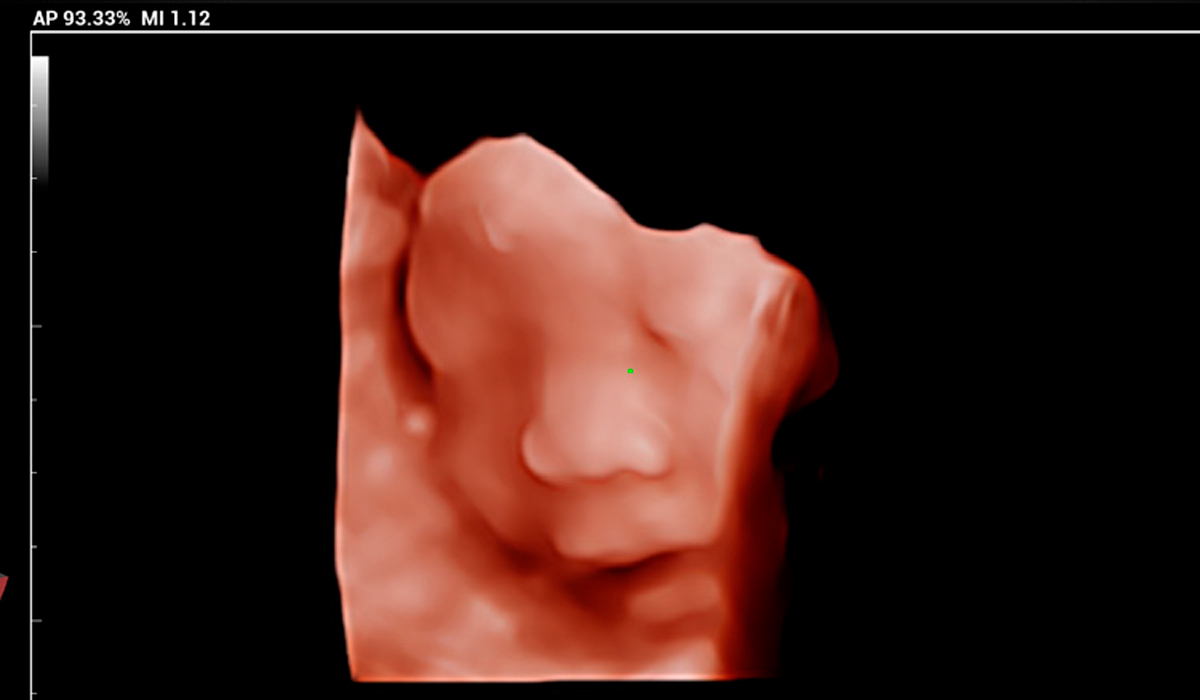 Mindray MX7 Elite Edition