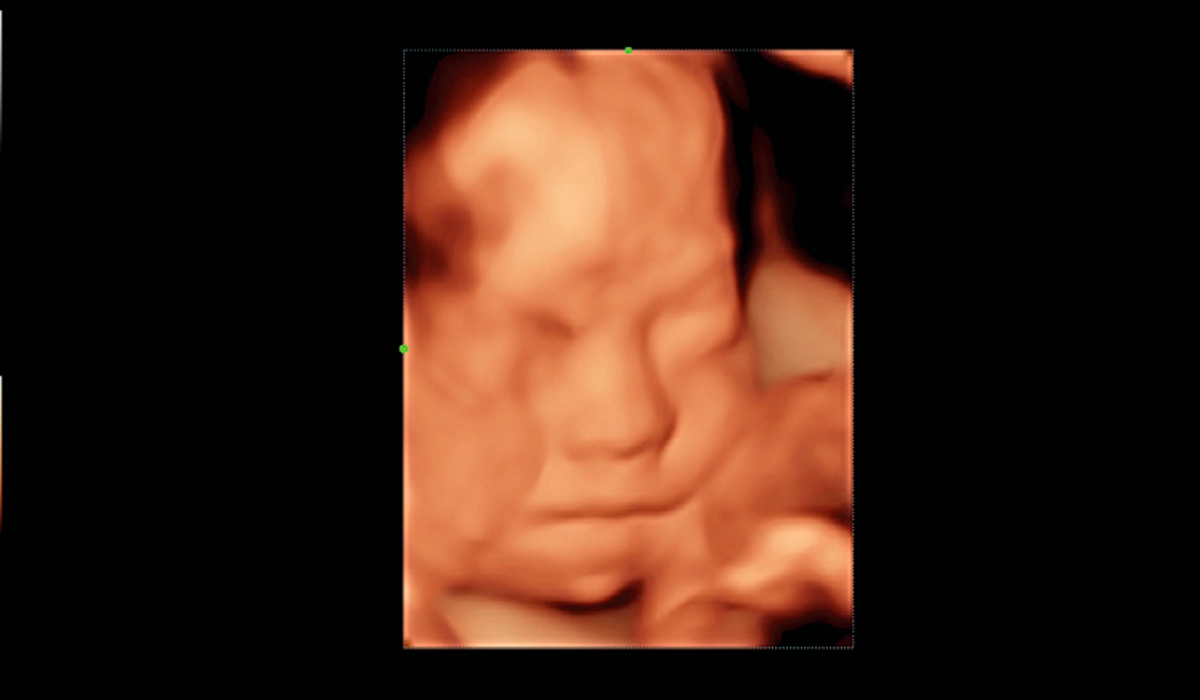 Mindray MX7 Elite Edition